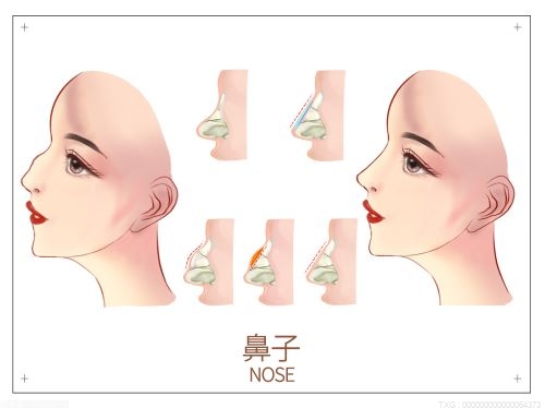 耳软骨隆鼻一般能维持几年？做鼻子留疤了怎么去除？